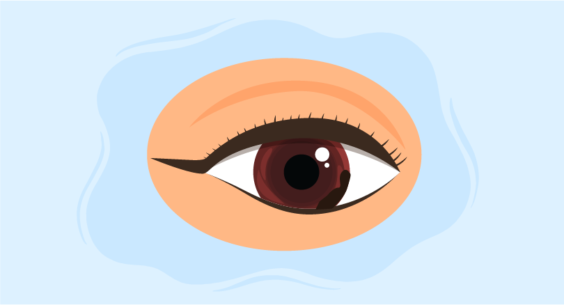 image of an eye highlighting choroidal and Malignant Melanoma