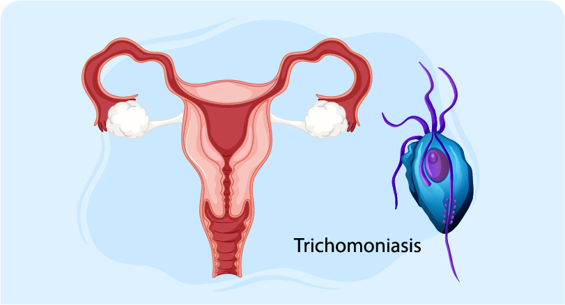 How to diagnose trichomoniasis