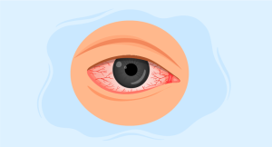 close-up image of an eye highlighting complexities of Wyburn-Mason Syndrome