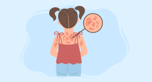 small girl with burns on her shoulders and upper back highlighting Surgical Treatment of Burns in Children