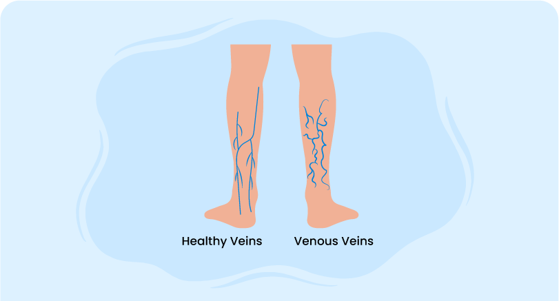 Comparison of healthy veins and venous veins in legs, illustrating lower extremity chronic venous disease
