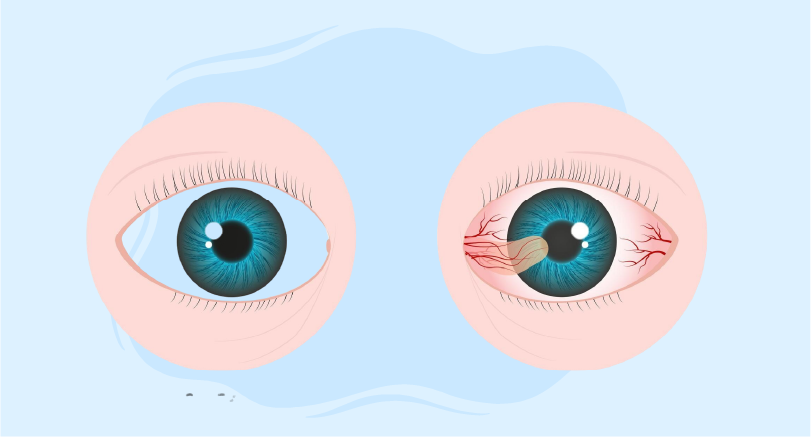Granulomatous iritis treatments
